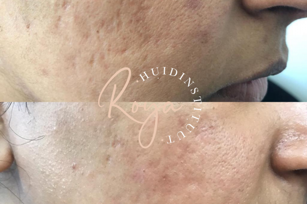 Microdermabrasie