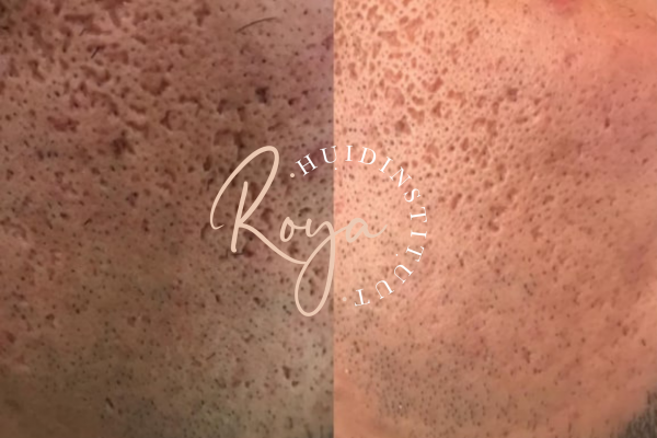 Microneedling