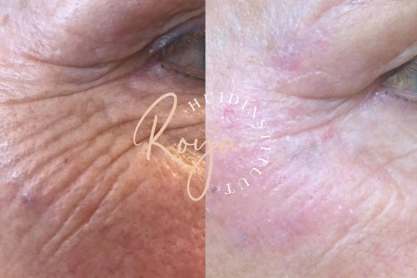 Plasma lift